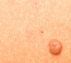 Moles and skin cancer.