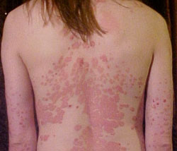 Psoriasis and Heart Disease
