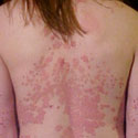 Psoriasis and Heart Disease