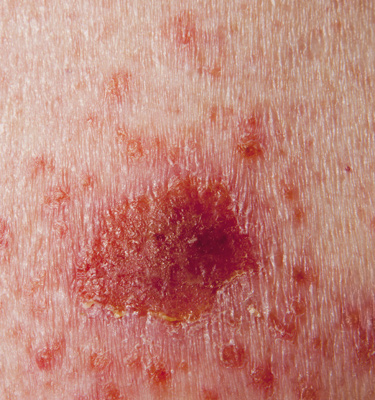 Skin Cancer Detection
