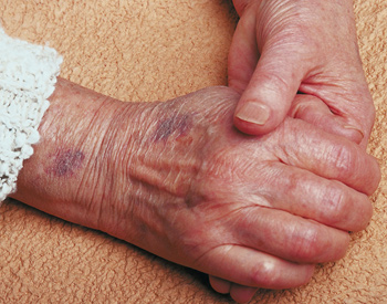 Bruising In Older Skin