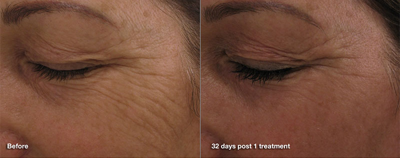 Pearl Fractional Treatments In Red Bluff At Vita Dermatology