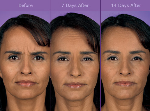 Botox Before And After Photos