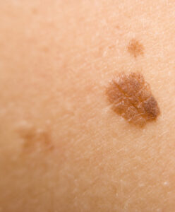 Basal Cell Carcinoma, Skin Cancer Tumors