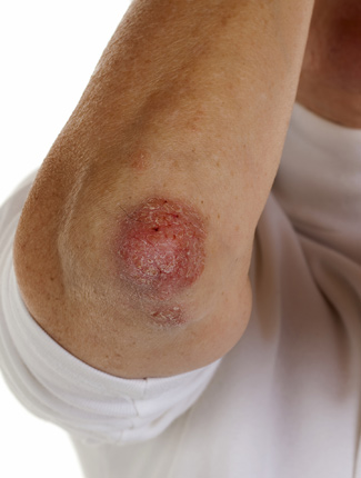 Signs And Symptoms Of Lyme Disease