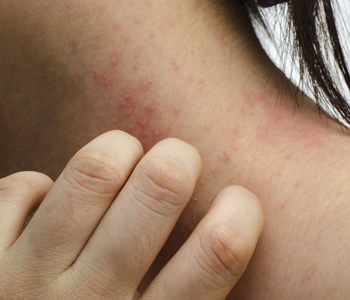 Psoriasis Symptoms, Eczema Symptoms