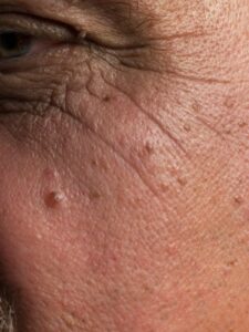 Moles And Skin Cancer